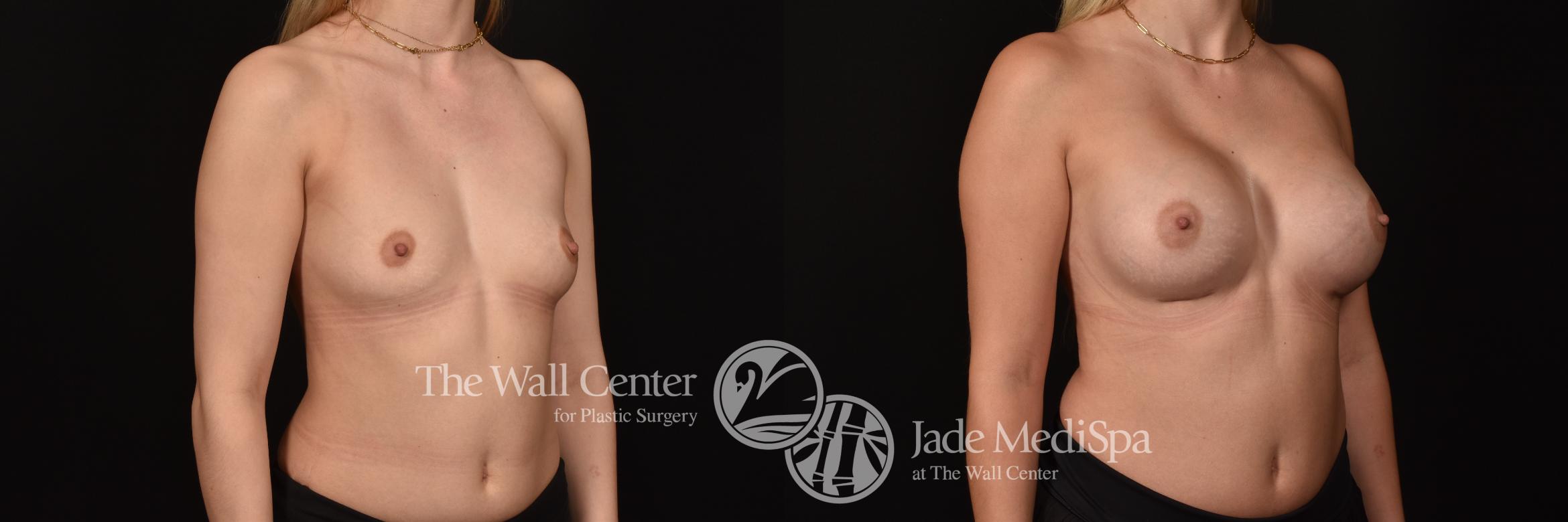 Before & After Breast Augmentation Case 1127 Right Oblique View in Shreveport, LA