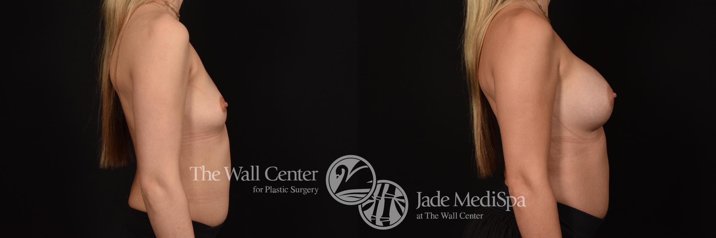 Before & After Breast Augmentation Case 1127 Right Side View in Shreveport, LA