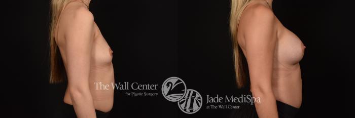 Before & After Breast Augmentation Case 1127 Right Side View in Shreveport, LA