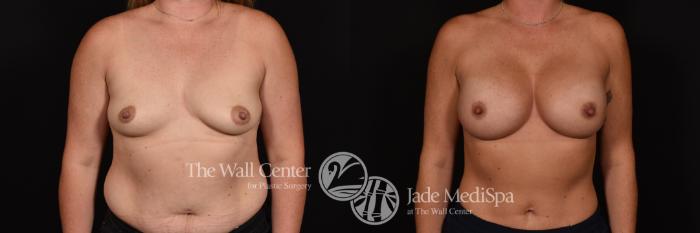Before & After Breast Augmentation Case 1128 Front View in Shreveport, LA
