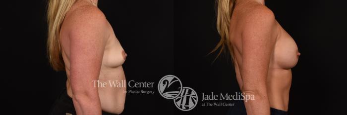 Before & After Breast Augmentation Case 1128 Right Side View in Shreveport, LA