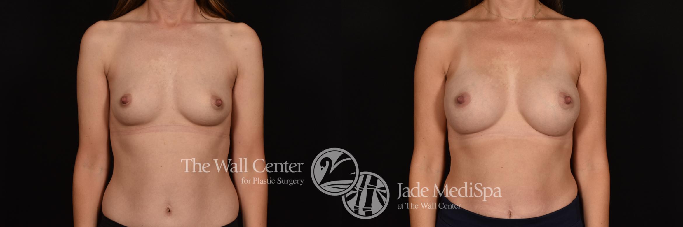 Before & After Breast Augmentation Case 1130 Front View in Shreveport, LA