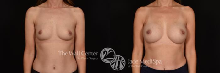 Before & After Breast Augmentation Case 1130 Front View in Shreveport, LA