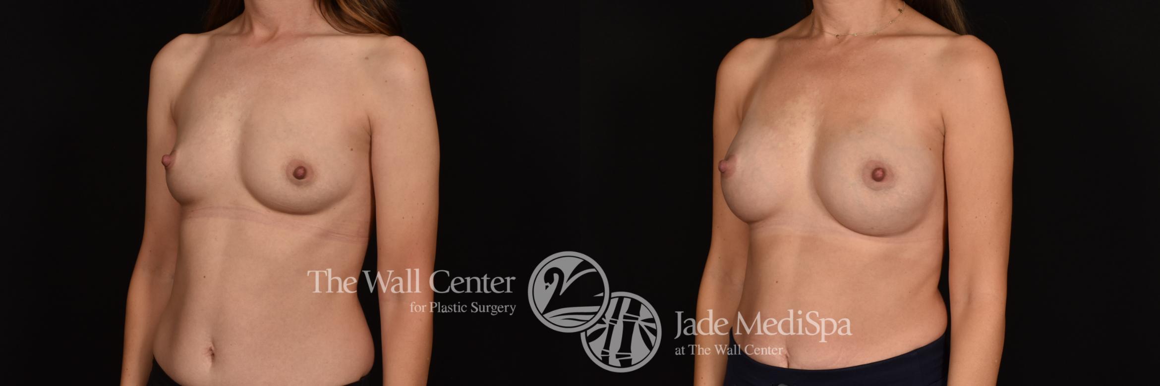 Before & After Breast Augmentation Case 1130 Left Oblique View in Shreveport, LA