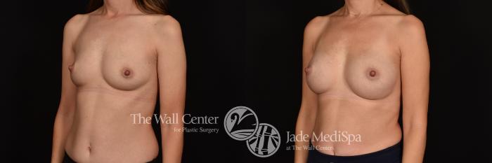 Before & After Breast Augmentation Case 1130 Left Oblique View in Shreveport, LA