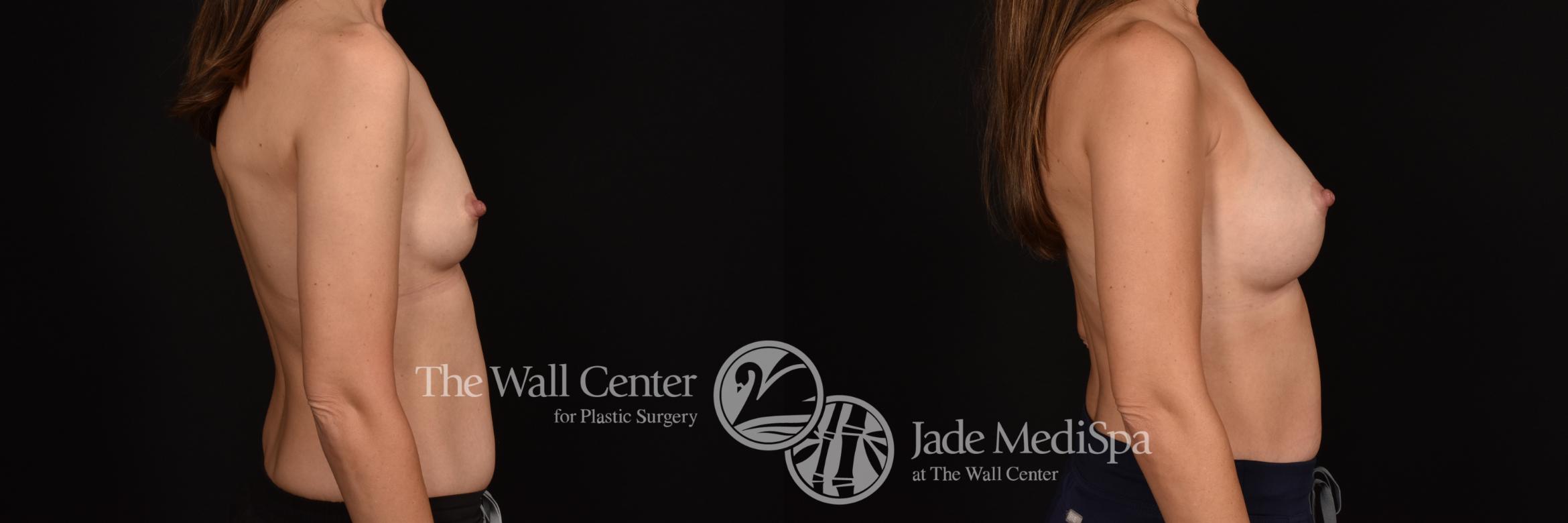 Before & After Breast Augmentation Case 1130 Right Side View in Shreveport, LA