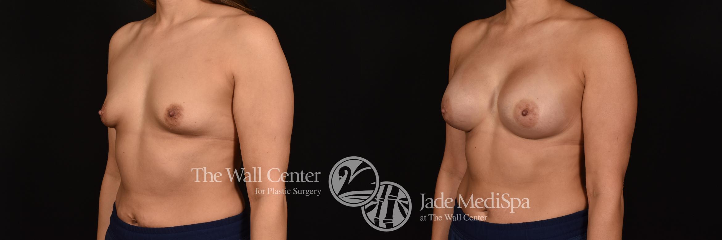 Before & After Breast Augmentation Case 1134 Left Oblique View in Shreveport, LA