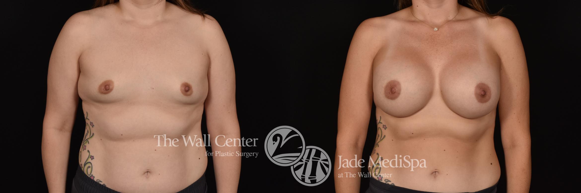 Before & After Breast Augmentation Case 1135 Front View in Shreveport, LA