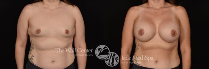 Before & After Breast Augmentation Case 1135 Front View in Shreveport, LA