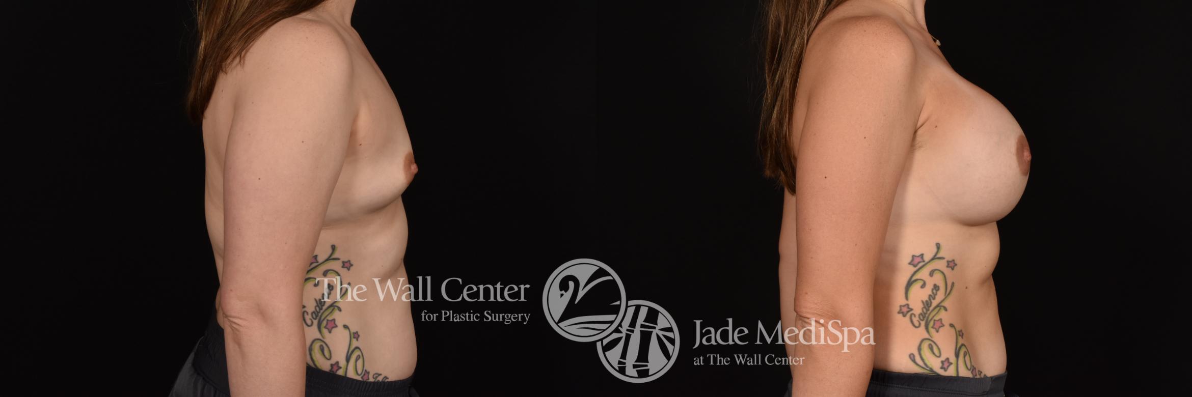Before & After Breast Augmentation Case 1135 Right Side View in Shreveport, LA