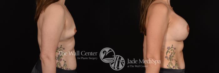 Before & After Breast Augmentation Case 1135 Right Side View in Shreveport, LA