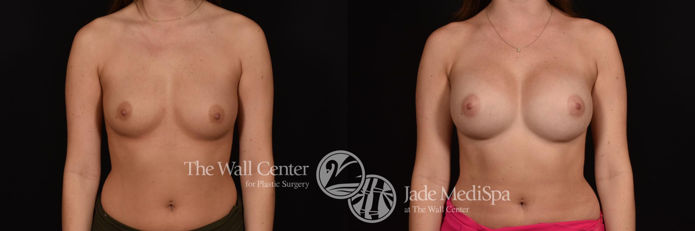 Before & After Breast Augmentation Case 1140 Front View in Shreveport, LA