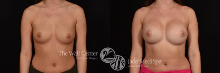 Before & After Breast Augmentation Case 1140 Front View in Shreveport, LA