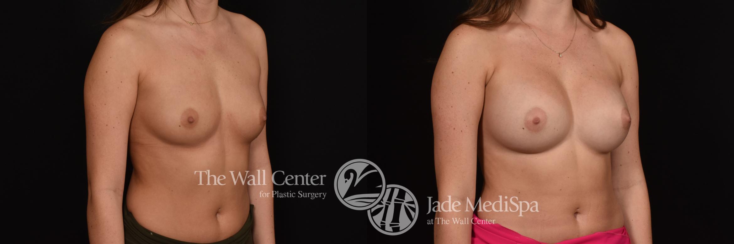 Before & After Breast Augmentation Case 1140 Right Oblique View in Shreveport, LA