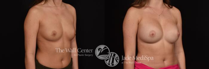 Before & After Breast Augmentation Case 1140 Right Oblique View in Shreveport, LA