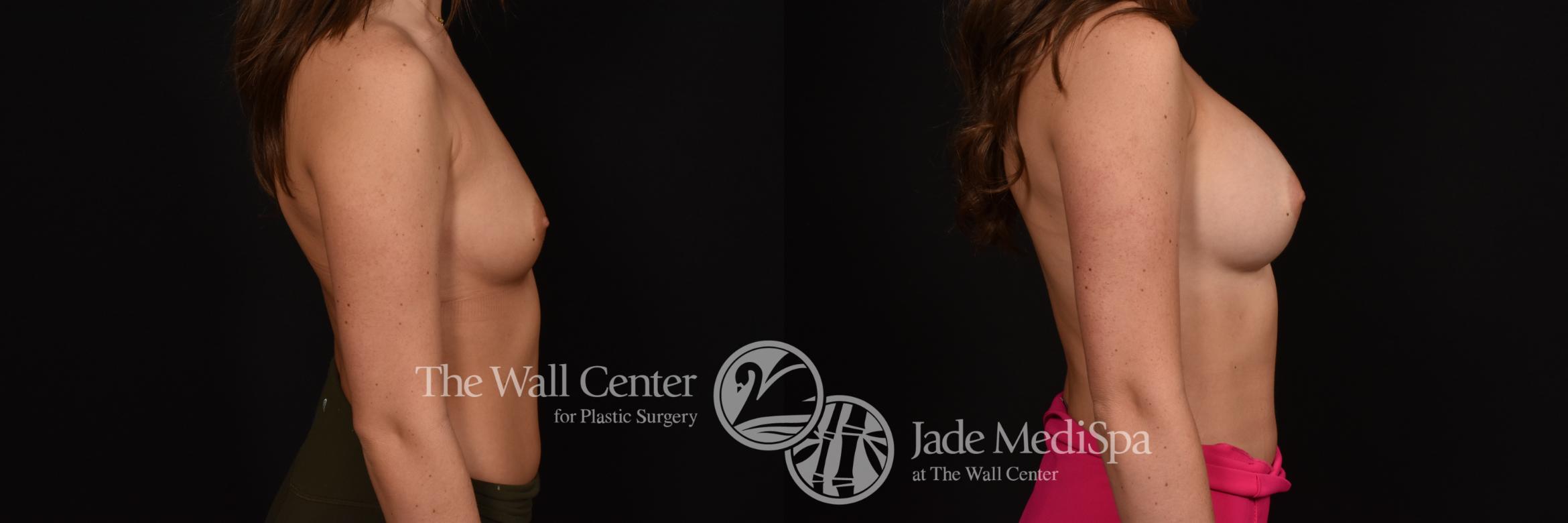 Before & After Breast Augmentation Case 1140 Right Side View in Shreveport, LA