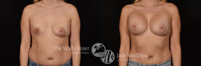 Before & After Breast Augmentation Case 1144 Front View in Shreveport, LA