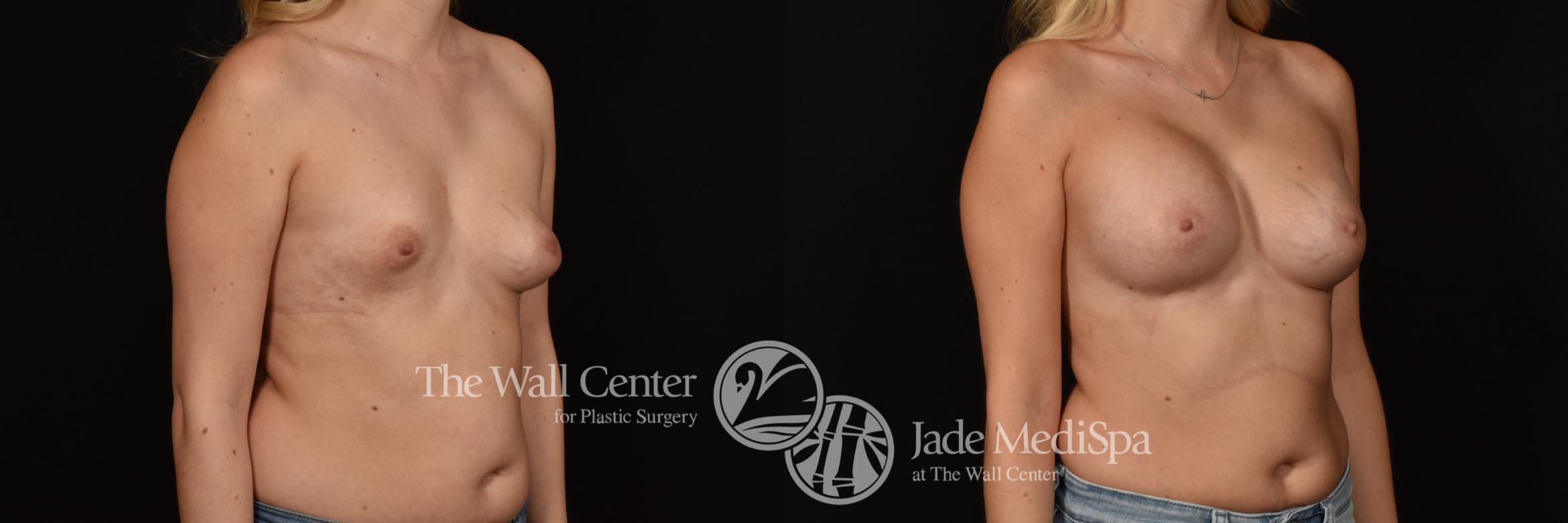 Before & After Breast Augmentation Case 1144 Right Oblique View in Shreveport, LA