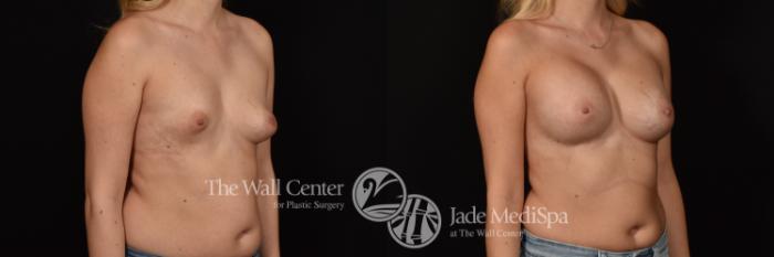 Before & After Breast Augmentation Case 1144 Right Oblique View in Shreveport, LA