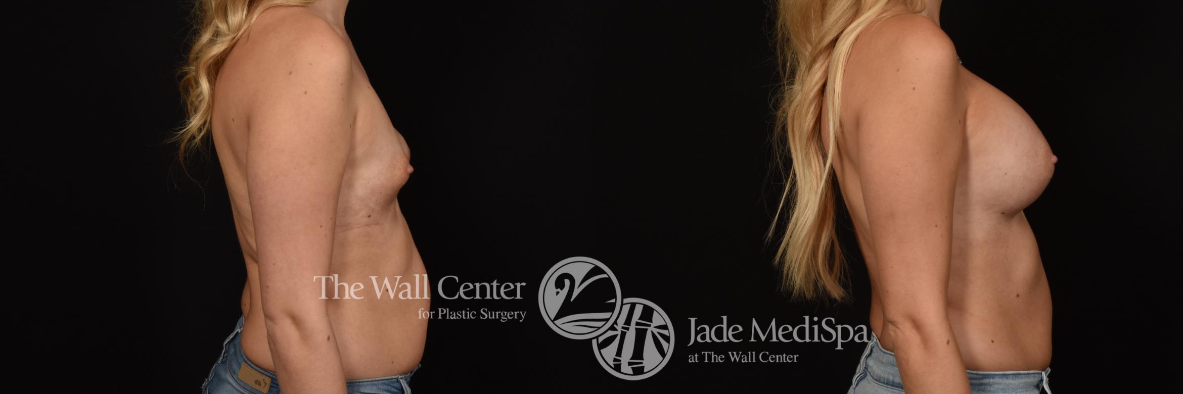 Before & After Breast Augmentation Case 1144 Right Side View in Shreveport, LA