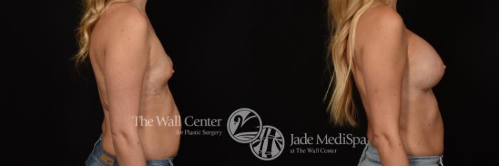 Before & After Breast Augmentation Case 1144 Right Side View in Shreveport, LA