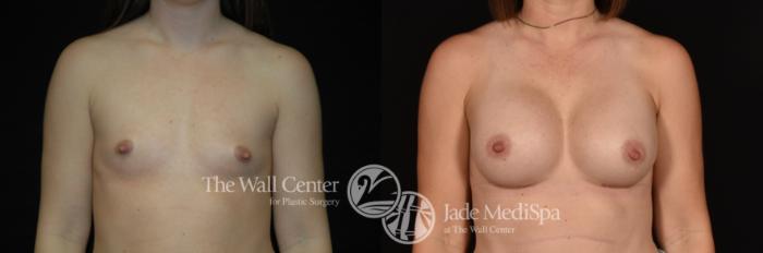 Before & After Breast Augmentation Case 1147 Front View in Shreveport, LA