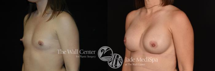 Before & After Breast Augmentation Case 1147 Left Oblique View in Shreveport, LA