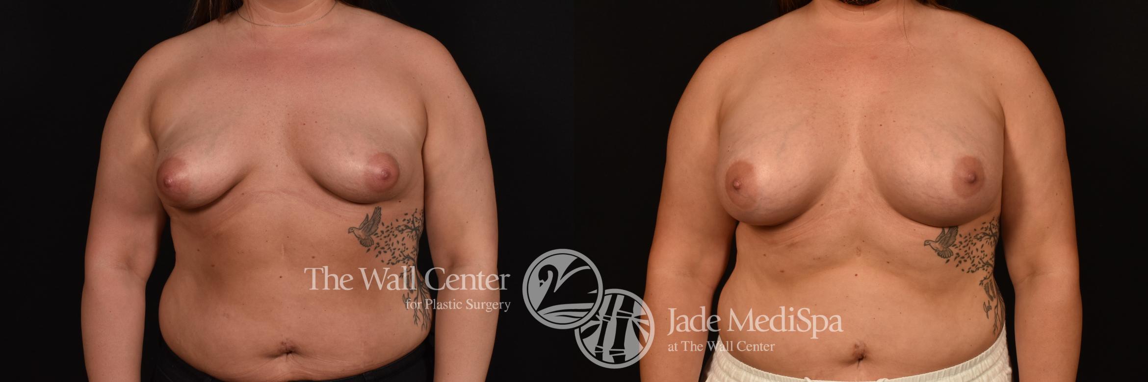 Before & After Breast Augmentation Case 1148 Front View in Shreveport, LA