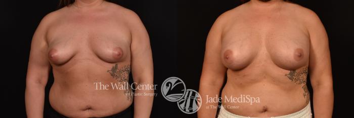 Before & After Breast Augmentation Case 1148 Front View in Shreveport, LA