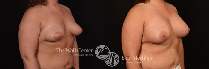 Before & After Breast Augmentation Case 1148 Right Oblique View in Shreveport, LA