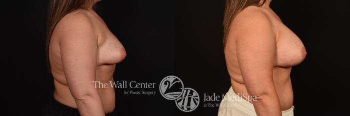 Before & After Breast Augmentation Case 1148 Right Side View in Shreveport, LA