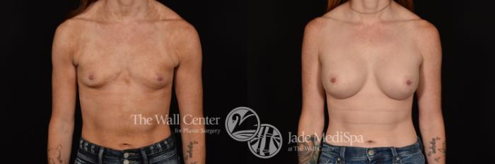 Before & After Breast Augmentation Case 1149 Front View in Shreveport, LA