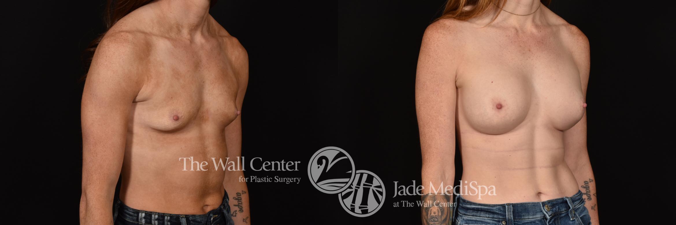 Before & After Breast Augmentation Case 1149 Right Oblique View in Shreveport, LA