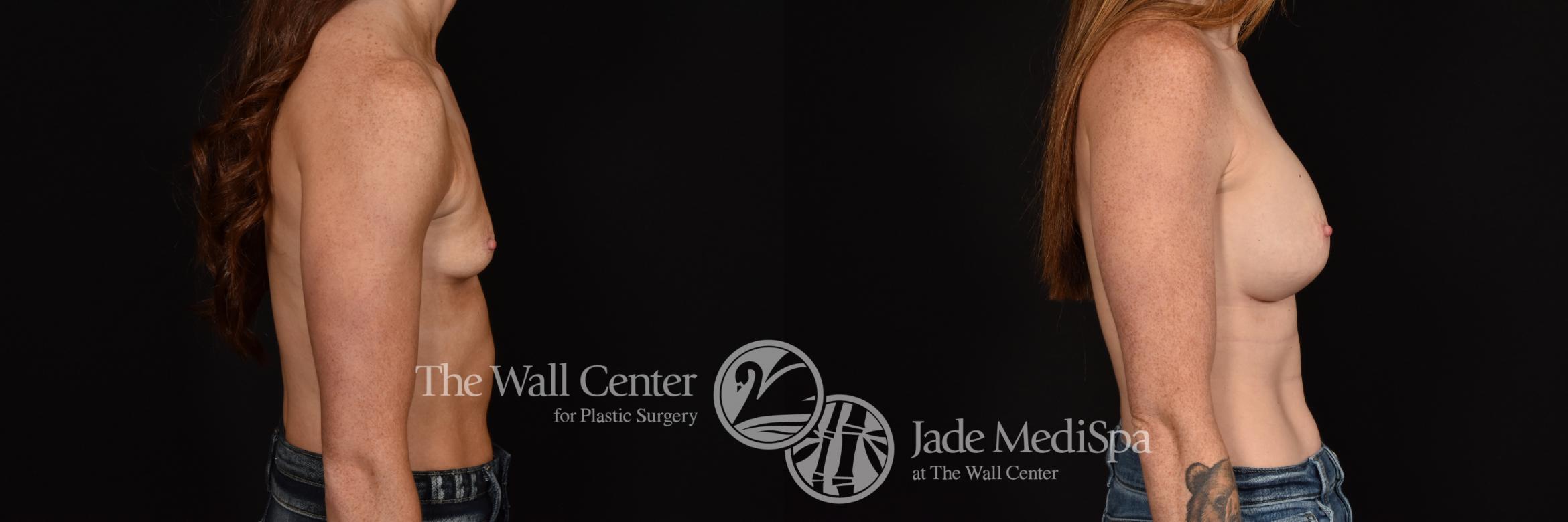 Before & After Breast Augmentation Case 1149 Right Side View in Shreveport, LA