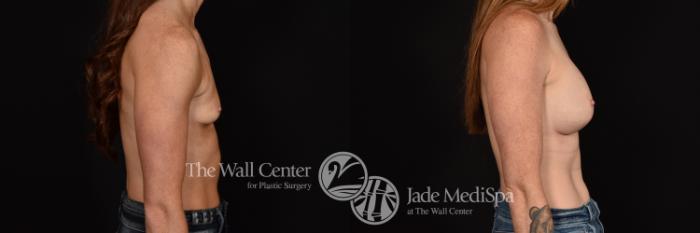 Before & After Breast Augmentation Case 1149 Right Side View in Shreveport, LA