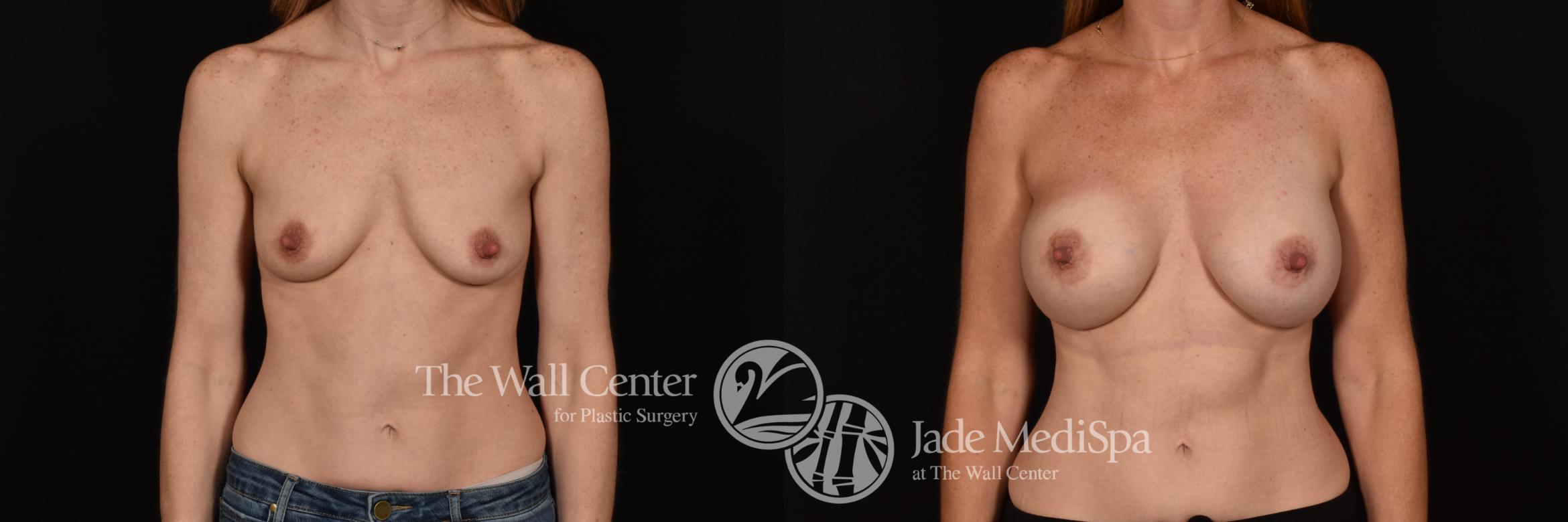 Before & After Breast Augmentation Case 1150 Front View in Shreveport, LA