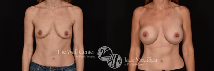 Before & After Breast Augmentation Case 1150 Front View in Shreveport, LA