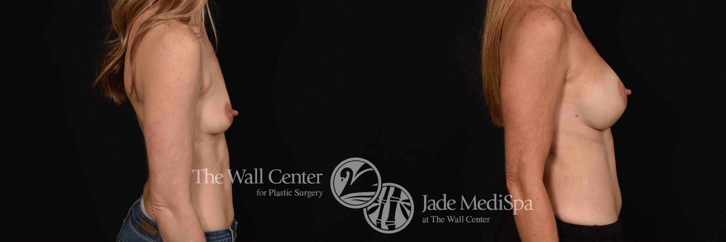 Before & After Breast Augmentation Case 1150 Right Side View in Shreveport, LA