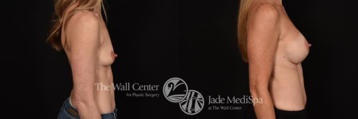 Before & After Breast Augmentation Case 1150 Right Side View in Shreveport, LA