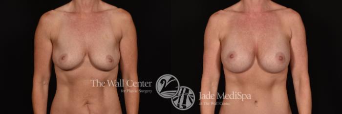 Before & After Breast Augmentation Case 1151 Front View in Shreveport, LA