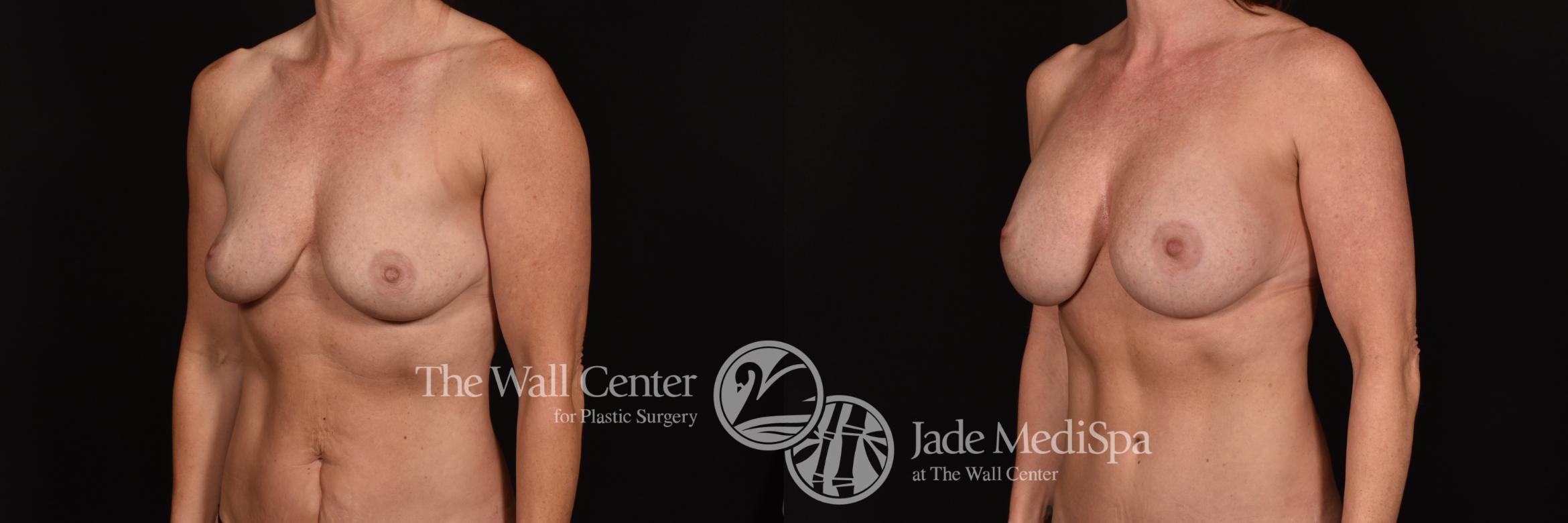 Before & After Breast Augmentation Case 1151 Left Oblique View in Shreveport, LA
