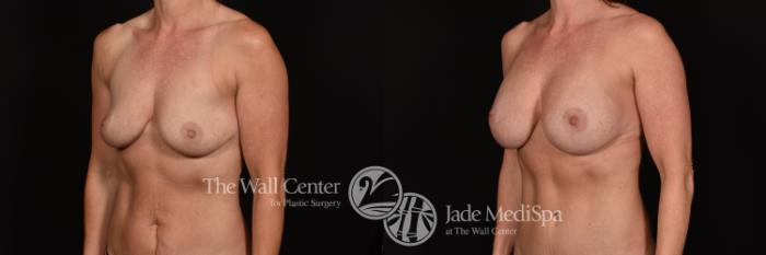 Before & After Breast Augmentation Case 1151 Left Oblique View in Shreveport, LA