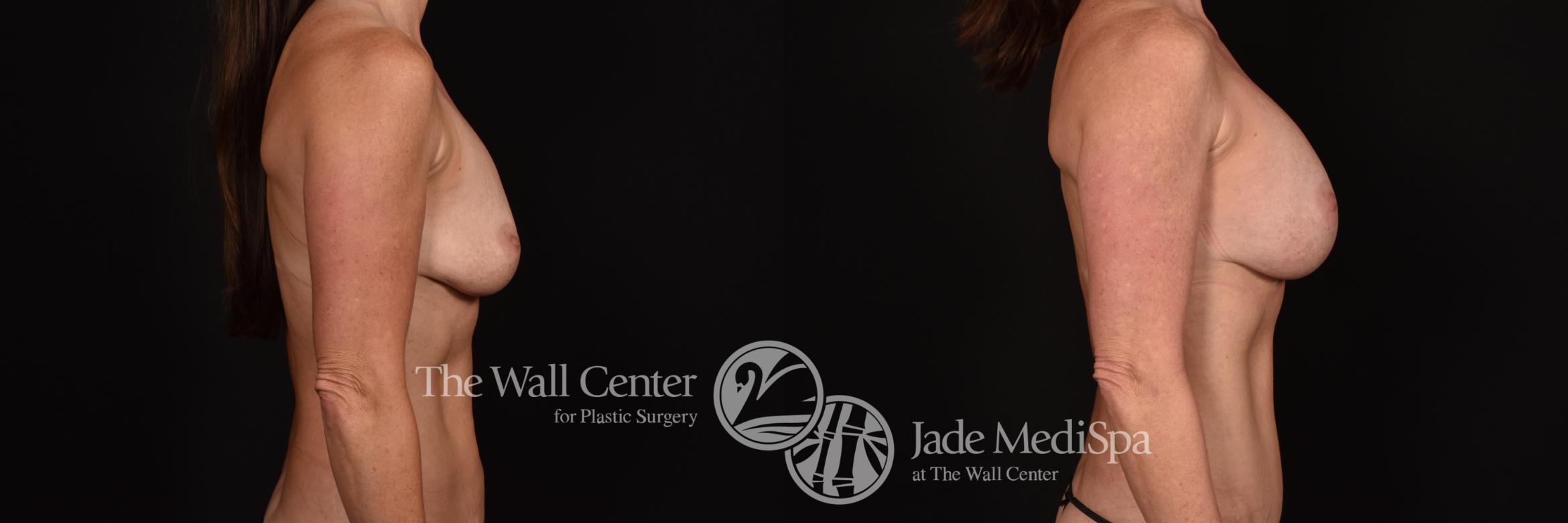 Before & After Breast Augmentation Case 1151 Right Side View in Shreveport, LA
