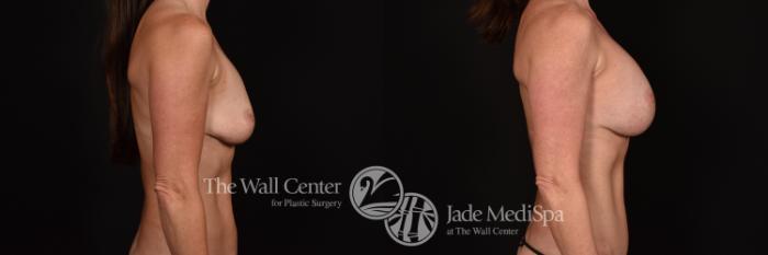 Before & After Breast Augmentation Case 1151 Right Side View in Shreveport, LA
