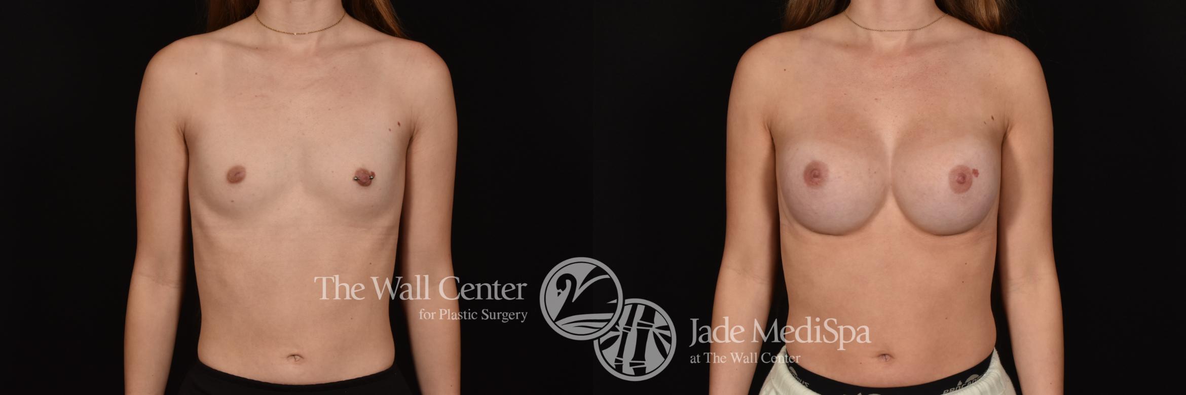 Before & After Breast Augmentation Case 1155 Front View in Shreveport, LA