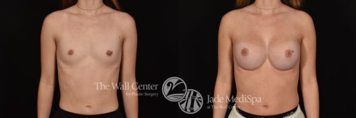 Before & After Breast Augmentation Case 1155 Front View in Shreveport, LA