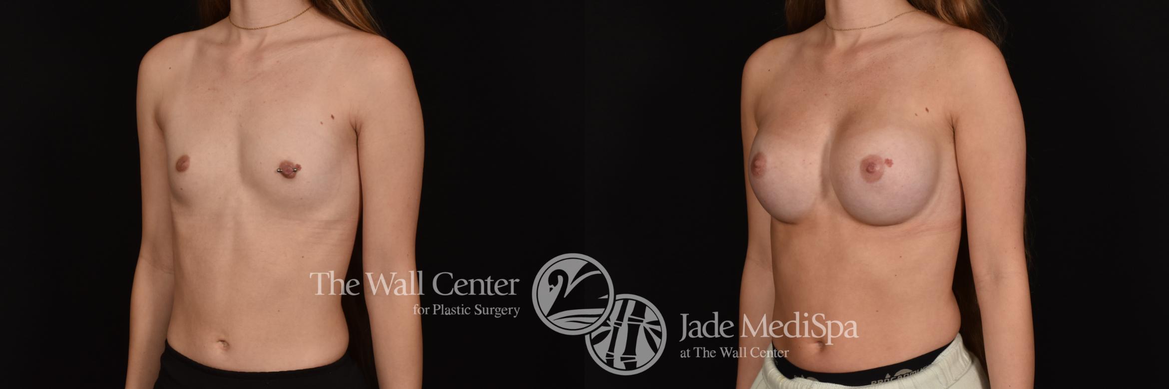 Before & After Breast Augmentation Case 1155 Left Oblique View in Shreveport, LA