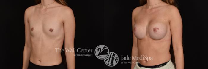 Before & After Breast Augmentation Case 1155 Left Oblique View in Shreveport, LA