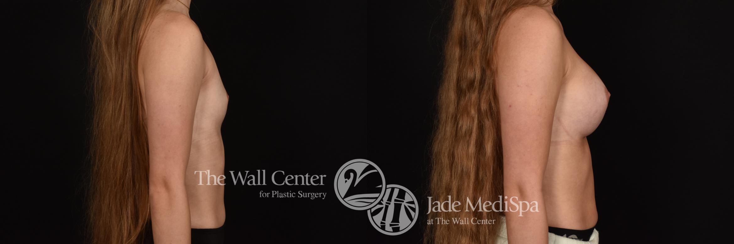 Before & After Breast Augmentation Case 1155 Right Side View in Shreveport, LA