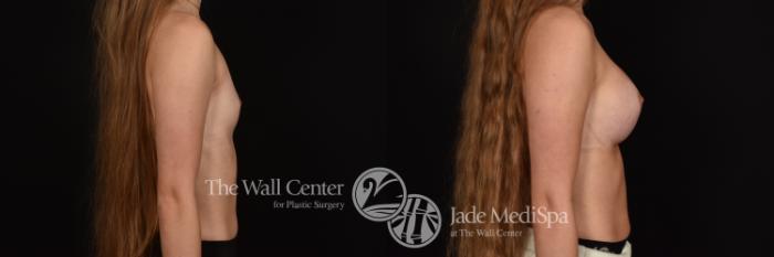 Before & After Breast Augmentation Case 1155 Right Side View in Shreveport, LA